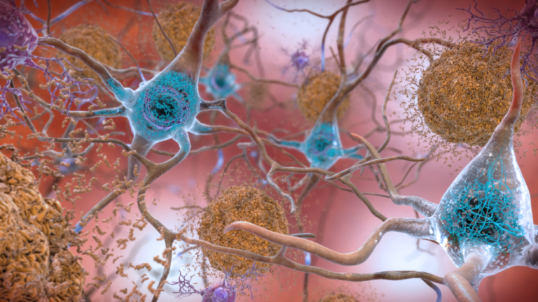 Beta-Amyloid Plaques and Tau in the Brain (38686503251) — Alzheimer: les médicaments stars déçoivent enfin