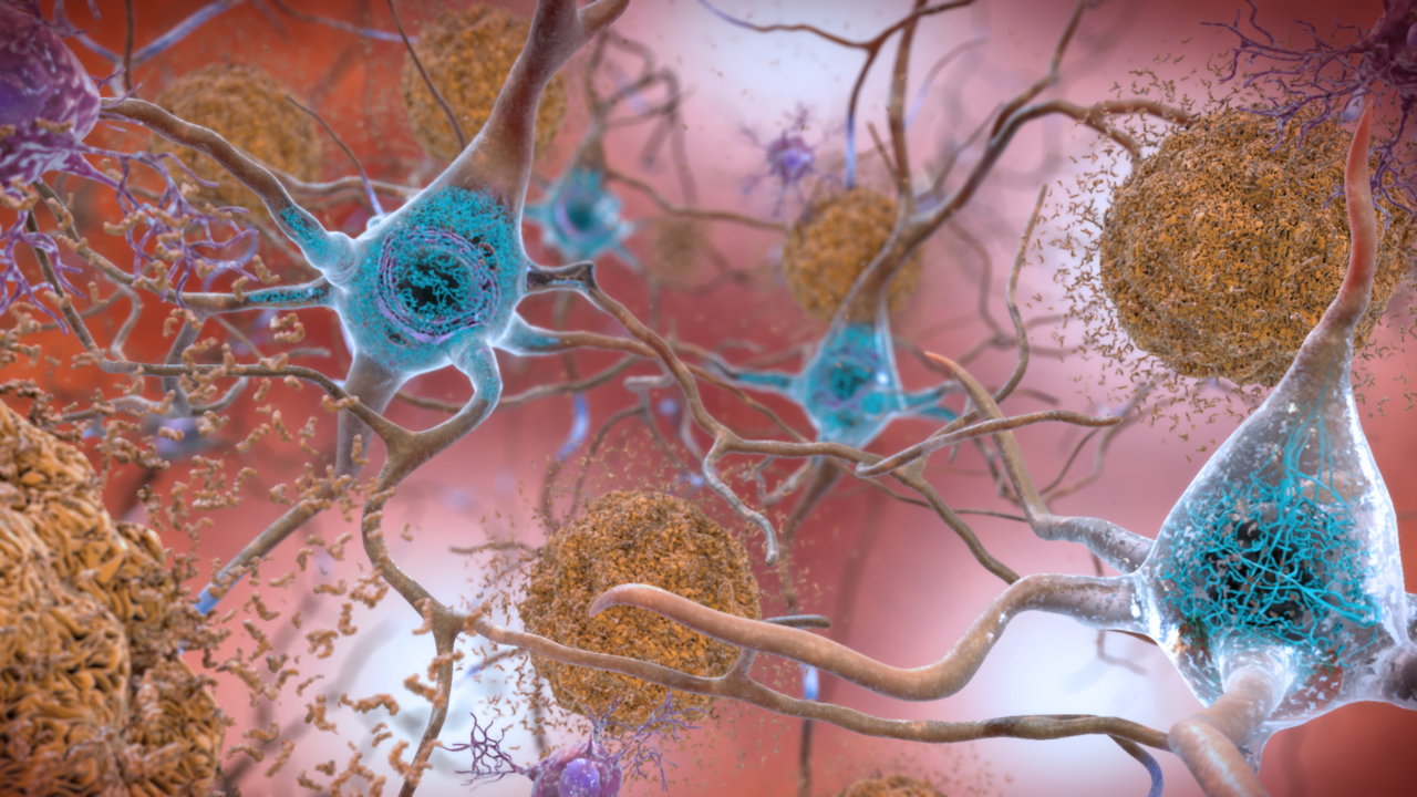 Beta-Amyloid Plaques and Tau in the Brain (38686503251) — Alzheimer: les médicaments stars déçoivent enfin