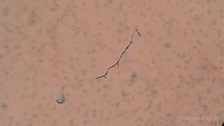 Chlamydospore of Candida albicans in LPCB preparation — Le champignon qui sonne à notre porte cellulaire